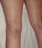after spider vein removal back legs view female patient case 3026