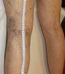 before spider vein removal back legs view female patient case 3026