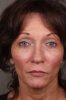after Voluma treatment female patient front view case 3781