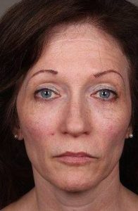 before Voluma treatment female patient front view case 3781