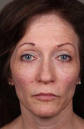 before Voluma treatment female patient front view case 3781