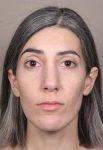 after Voluma treatment female patient front view case 3784