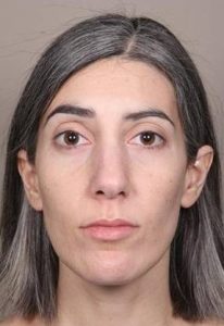 after Voluma treatment female patient front view case 3784