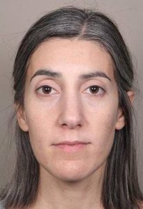 before Voluma treatment female patient front view case 3784