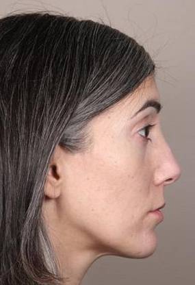 after Voluma treatment female patient right side view case 3784