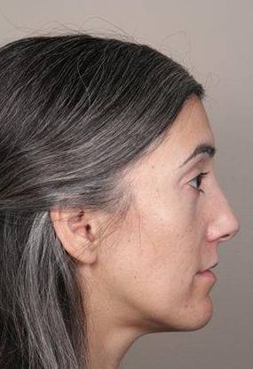 before Voluma treatment female patient right side view case 3784