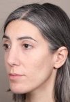 after Voluma treatment female patient front diagonal view case 3784