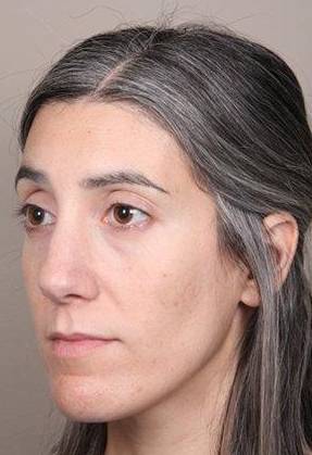before Voluma treatment female patient left diagonal view case 3784