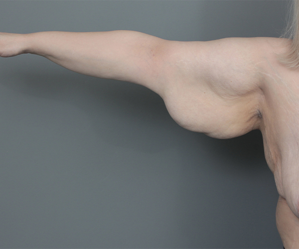 before arm lift female patient front view case 5715