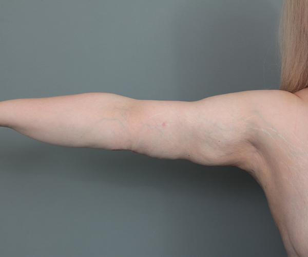 after arm lift female patient front view case 5715