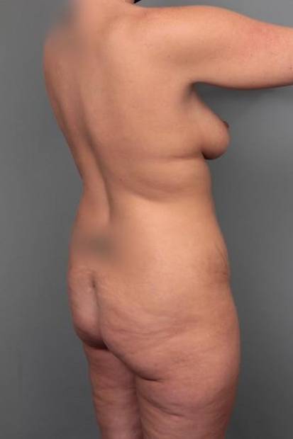 before brazilian butt lift angle view case 4121