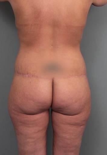 after brazilian butt lift back view case 4124