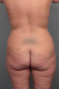 before brazilian butt lift back view case 4124