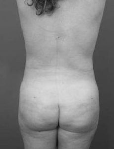 after brazilian butt lift back view case 4121