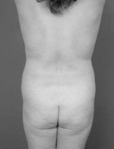 before brazilian butt lift back view case 4121