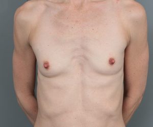 before breast augmentation front view case 5693