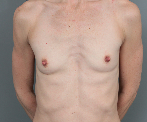 before breast augmentation front view case 5693