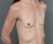 before breast augmentation right angle view case 5693
