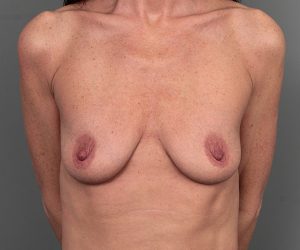 before breast augmentation front view case 5708