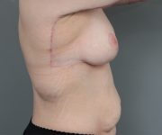 after breast lift right side view case 5655