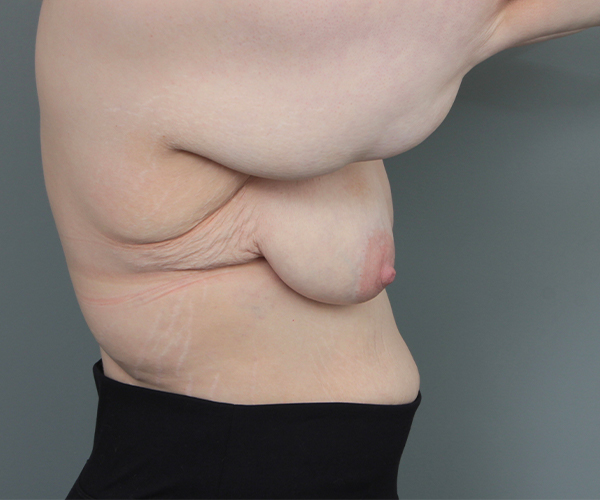before breast lift right side view case 5655