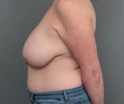 before breast reduction left side case 5681