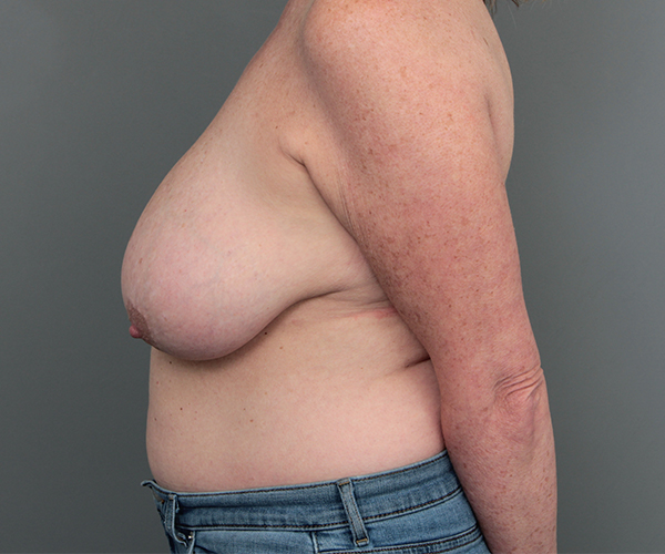 before breast reduction left side case 5681