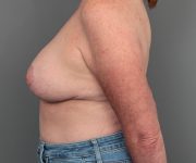 after breast reduction left side view case 5681