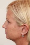 before brow lift side view case 4227