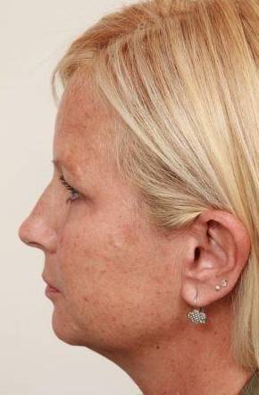 before brow lift side view case 4227