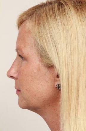 after brow lift side view case 4227