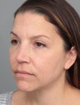 after dermal fillers left angled view female patient case 5669