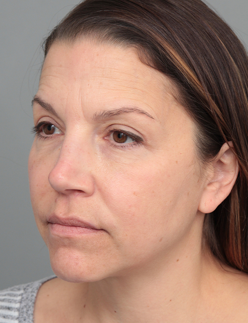 after dermal fillers left angled view female patient case 5669