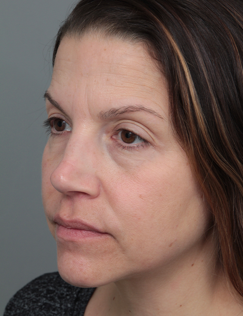 before dermal fillers left angled view female patient case 5669