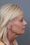 before facelift/neck lift female patient right side view case 5816