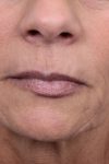 before facelift/neck lift female patient mouth close up case 5816
