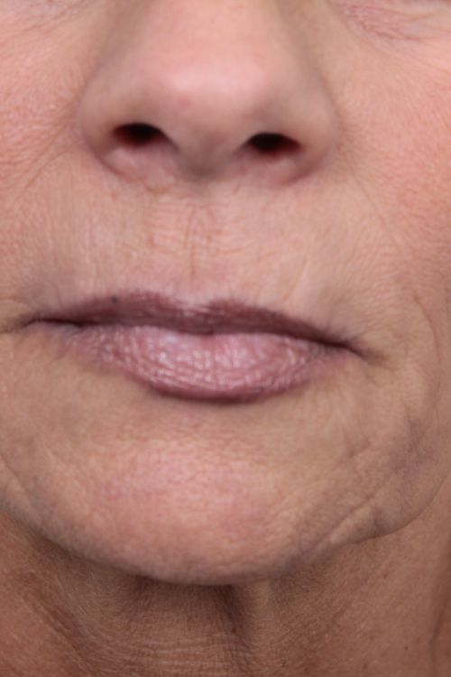 before facelift/neck lift female patient mouth close up case 5816