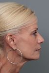 after facelift/neck lift female patient right side view case 5816