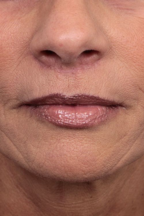 after facelift/neck lift female patient mouth close up case 5816