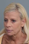 before facelift/neck lift female patient left angle view case 5816