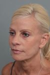 after facelift/neck lift female patient left angle view case 5816