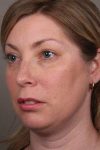 before facial implants left angle view case 4219