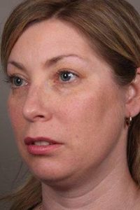 before facial implants left angle view case 4219