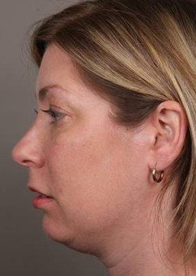 before facial implants left side view case 4219