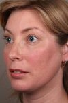 after facial implants left angle view case 4219