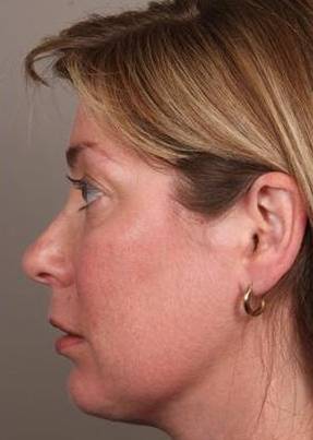 after facial implants left side view case 4219
