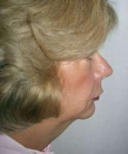 before Chin Implant with Facelift right view case 4224