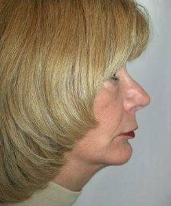 after Chin Implant with Facelift right view case 4224