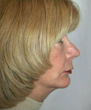 after Chin Implant with Facelift right view case 4224