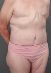 after lower body lift right angle front view case 3964